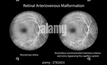 Malformation artério-veineuse rétinienne, illustration Banque D'Images