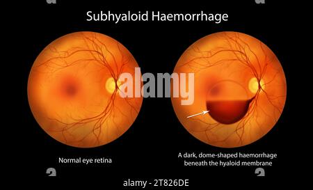 Hémorragie sous-hyaloïdienne sur la rétine, illustration Banque D'Images