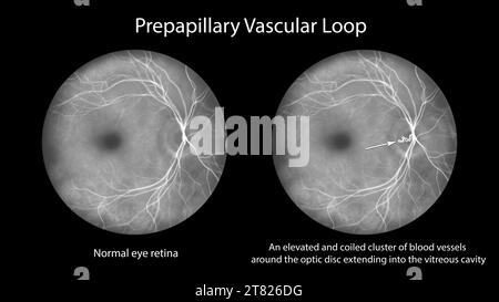 Illustration d'une anse vasculaire prépapillaire sur la rétine, observée au cours de l'angiographie fluorescéinique. Les vaisseaux sanguins en boucle sont autour de l'optique Banque D'Images