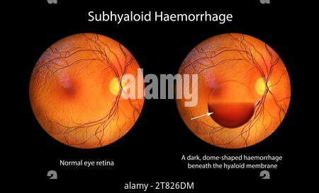 Illustration d'une hémorragie sous-hyaloïdienne sur la rétine observée au cours de l'ophtalmoscopie. Il y a une hémorragie sombre en forme de dôme sous la hyaloïde Banque D'Images