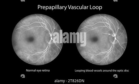 Anse vasculaire prépapillaire sur la rétine, illustration Banque D'Images