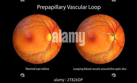 Anse vasculaire prépapillaire sur la rétine, illustration Banque D'Images