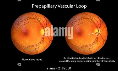 Illustration d'une anse vasculaire prépapillaire sur la rétine, observée lors de l'ophtalmoscopie. Les vaisseaux sanguins en boucle sont autour du disque optique. Banque D'Images