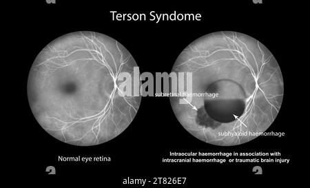 Hémorragie intraoculaire au cours d'un syndrome de Terson, illustration Banque D'Images