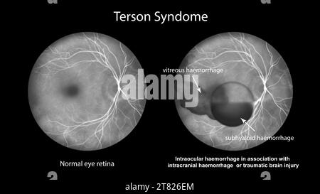 Illustration représentant un syndrome de Terson, révélant une hémorragie intraoculaire observée lors d'une angiographie fluorescéinique, liée à une hémorragie intracrânienne Banque D'Images