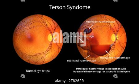 Hémorragie intraoculaire au cours d'un syndrome de Terson, illustration Banque D'Images