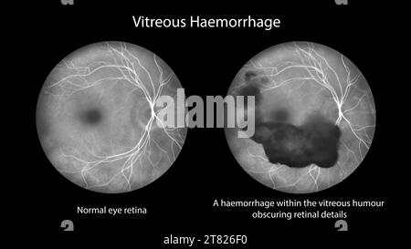 Hémorragie vitréenne, illustration Banque D'Images