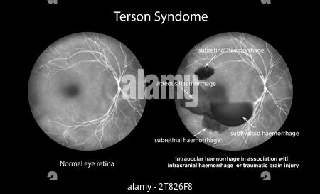 Hémorragie intraoculaire au cours d'un syndrome de Terson, illustration Banque D'Images