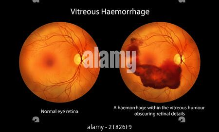 Hémorragie vitréenne, illustration Banque D'Images