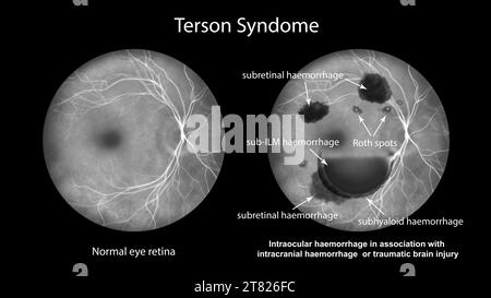 Hémorragie intraoculaire au cours d'un syndrome de Terson, illustration Banque D'Images