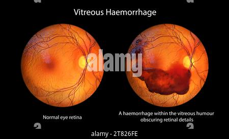 Hémorragie vitréenne, illustration Banque D'Images