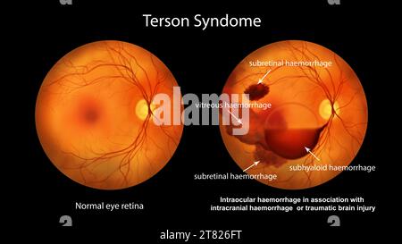 Hémorragie intraoculaire au cours d'un syndrome de Terson, illustration Banque D'Images