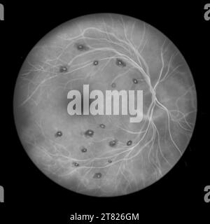 Illustration de taches de Roth dans la rétine observées en angiographie à la fluorescéine, montrant des hémorragies rétiniennes centrées sur le blanc avec hémorragies environnantes Banque D'Images