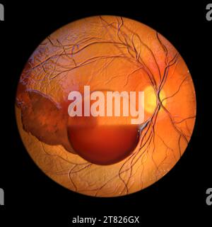 Illustration informatique représentant un syndrome de Terson, révélant une hémorragie intraoculaire observée lors d'une ophtalmoscopie, liée à une hémorragie intracrânienne Banque D'Images