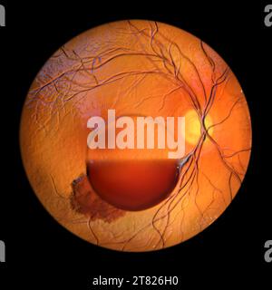 Hémorragie intraoculaire au cours d'un syndrome de Terson, illustration Banque D'Images