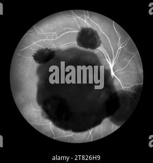 Illustration d'une hémorragie sous-rétinienne observée au cours d'une angiographie fluorescéinique révélant une hémorragie sombre et irrégulière sous les couches rétiniennes. Banque D'Images