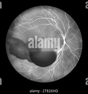 Hémorragie intraoculaire au cours d'un syndrome de Terson, illustration Banque D'Images