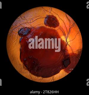 Illustration informatique d'une hémorragie sous-rétinienne observée lors de l'ophtalmoscopie, révélant une hémorragie sombre et irrégulière sous les couches rétiniennes. Banque D'Images