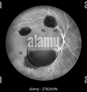 Hémorragie intraoculaire au cours d'un syndrome de Terson, illustration Banque D'Images