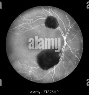 Illustration d'une hémorragie sous-rétinienne observée au cours d'une angiographie fluorescéinique révélant une hémorragie sombre et irrégulière sous les couches rétiniennes. Banque D'Images