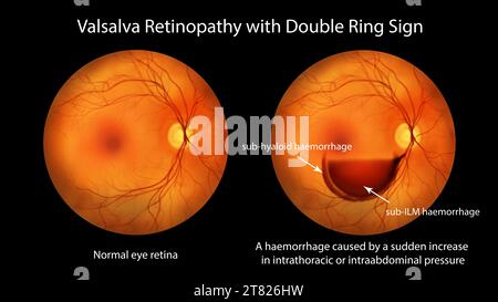 Rétinopathie de Valsava, illustration Banque D'Images