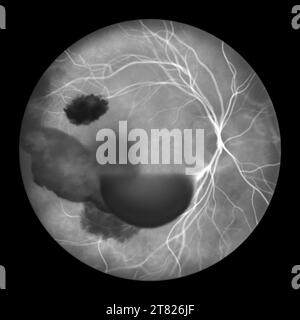 Hémorragie intraoculaire au cours d'un syndrome de Terson, illustration Banque D'Images