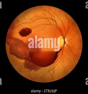 Illustration représentant un syndrome de Terson, révélant une hémorragie intraoculaire observée lors d'une ophtalmoscopie, liée à une hémorragie intracrânienne ou à un traumatisme Banque D'Images