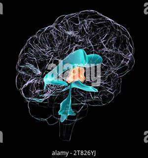 Troisième ventricule du cerveau élargi, illustration Banque D'Images