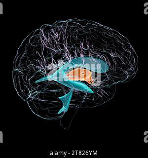 Troisième ventricule du cerveau élargi, illustration Banque D'Images