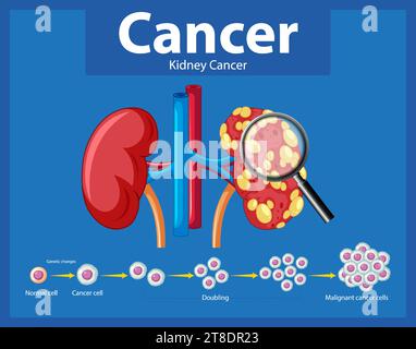 Infographie illustrée illustrant le processus de développement du cancer dans le rein humain Illustration de Vecteur