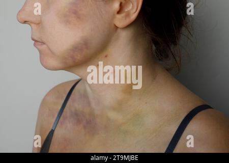 Cicatrice d'accident de voiture, traitement de l'embolie pulmonaire ou concept de soutien à la violence domestique. Femme avec ecchymose et cicatrice gros plan Banque D'Images