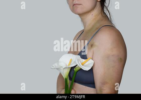 Jeune femme avec des bleus et fleur de lys blanc gros plan sur fond gris. Cicatrice d'accident de voiture, traitement de l'embolie pulmonaire ou violence domestique Banque D'Images