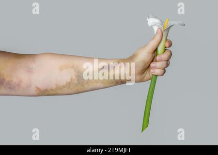 Main de femme avec ecchymose tenant la fleur blanche près sur fond gris. Cicatrice d'accident de voiture ou traitement de l'embolie pulmonaire Banque D'Images