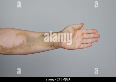 Main avec ecchymose gros plan sur fond gris Banque D'Images