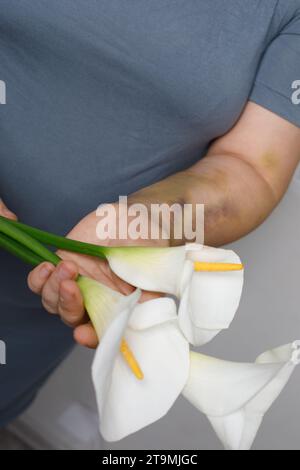Cicatrice d'accident de voiture, traitement de l'embolie pulmonaire ou concept de violence domestique. Main femelle avec bleu et fleur de lys blanc en gros plan. Banque D'Images