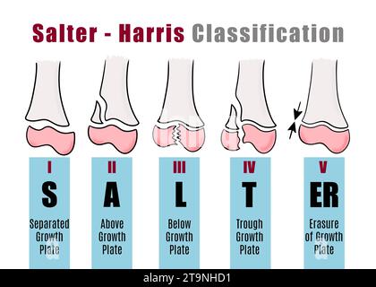 Salter - classification Harris pour reconnaître et identifier différents types de fractures osseuses. Illustration pour les étudiants Banque D'Images