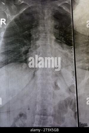 Une radiographie simple de la colonne vertébrale dorsale et lombaire révèle des modifications spondylotiques, un redressement de la colonne dorsale et lombaire, des espaces discaux intervertébraux intacts, Banque D'Images