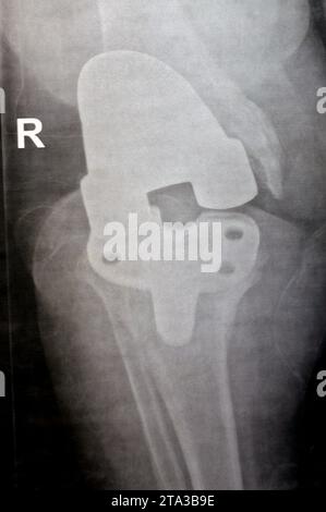 Radiographie simple montrant une arthroplastie totale de remplacement du genou droit après arthrose articulaire de grade 4, une intervention chirurgicale pour remplacer les s porteurs Banque D'Images