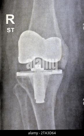 Radiographie simple montrant une arthroplastie totale de remplacement du genou droit après arthrose articulaire de grade 4, une intervention chirurgicale pour remplacer les s porteurs Banque D'Images