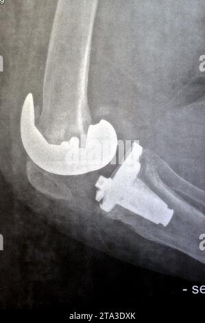 Radiographie simple montrant une arthroplastie totale de remplacement du genou droit après arthrose articulaire de grade 4, une intervention chirurgicale pour remplacer les s porteurs Banque D'Images