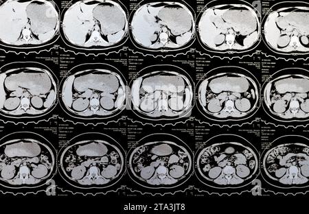 Le Caire, Égypte, octobre 3 2023 : le scanner multi-coupes de l'abdomen et du bassin montre un kyste de l'ovaire droit de 3 x 3 cm, une distension gazeuse colique, pas d'urine importante Banque D'Images