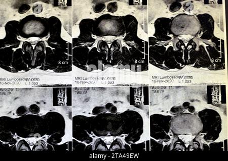 IRM rachis lombo-sacré sans produit de contraste a révélé un spasme musculaire du dos, de légères lésions discales L3-L4, L4-L5, hémangiome des vertèbres sacrées, L5 et T12, Banque D'Images