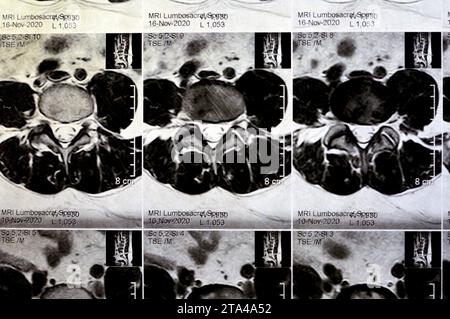 IRM rachis lombo-sacré sans produit de contraste a révélé un spasme musculaire du dos, de légères lésions discales L3-L4, L4-L5, hémangiome des vertèbres sacrées, L5 et T12, Banque D'Images