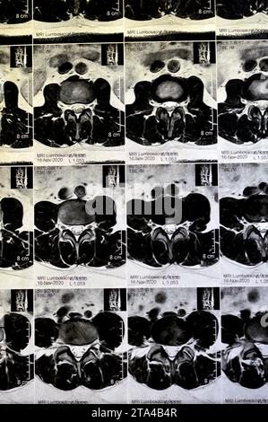 IRM rachis lombo-sacré sans produit de contraste a révélé un spasme musculaire du dos, de légères lésions discales L3-L4, L4-L5, hémangiome des vertèbres sacrées, L5 et T12, Banque D'Images