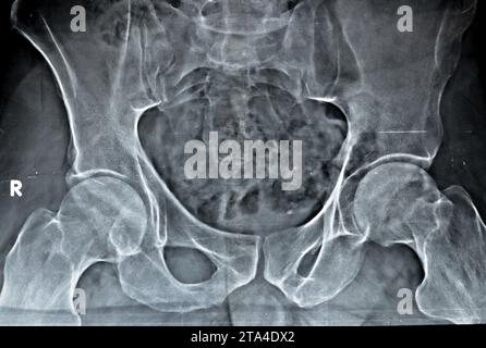 La radiographie simple des deux articulations de la hanche a révélé un léger rétrécissement de l'aspect superolatéral des deux espaces articulaires de la hanche avec sclérose sous-chondrale de l'a opposé Banque D'Images