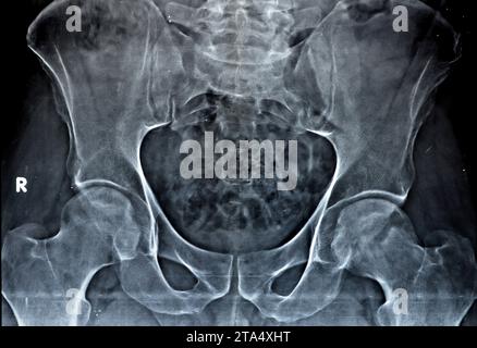 La radiographie simple des deux articulations de la hanche a révélé un léger rétrécissement de l'aspect superolatéral des deux espaces articulaires de la hanche avec sclérose sous-chondrale de l'a opposé Banque D'Images