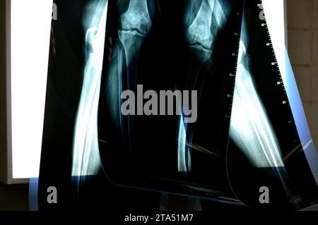 Rouleaux de radiographie simple d'un cas médical avant l'opération totale de remplacement du genou, arthrose de l'articulation du genou, avec ostéophytes définis et espace articulaire narr Banque D'Images