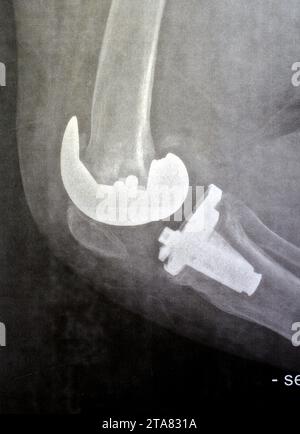 Radiographie simple montrant une arthroplastie totale de remplacement du genou droit après arthrose articulaire de grade 4, une intervention chirurgicale pour remplacer les s porteurs Banque D'Images