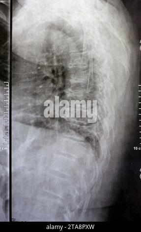 Une radiographie simple de la colonne vertébrale dorsale et lombaire révèle des modifications spondylotiques, un redressement de la colonne dorsale et lombaire, des espaces discaux intervertébraux intacts, Banque D'Images