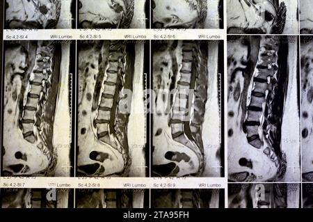 IRM rachis lombo-sacré sans produit de contraste a révélé un spasme musculaire du dos, de légères lésions discales L3-L4, L4-L5, hémangiome des vertèbres sacrées, L5 et T12, Banque D'Images